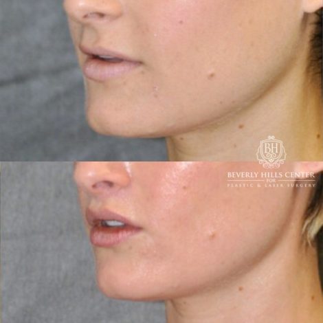 Beverly Hills Center Female Patient Before and After CUPID LIFT® Lip Lift Procedure