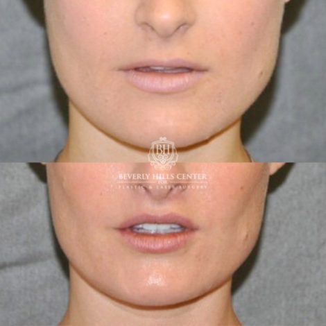 Beverly Hills Center Female Patient Before and After CUPID LIFT® Lip Lift Procedure