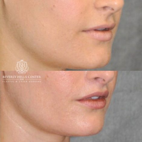 Beverly Hills Center Female Patient Before and After CUPID LIFT® Lip Lift Procedure