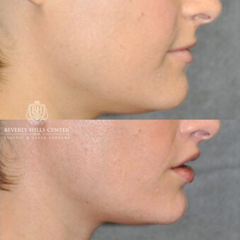 Beverly Hills Center Female Patient Before and After CUPID LIFT® Lip Lift Procedure