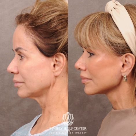 Beverly Hills Center Female Patient Before and After AuraLyft, Cupid Lift Lip Lift, Nanofat