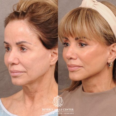Beverly Hills Center Female Patient Before and After AuraLyft, Cupid Lift Lip Lift, Nanofat