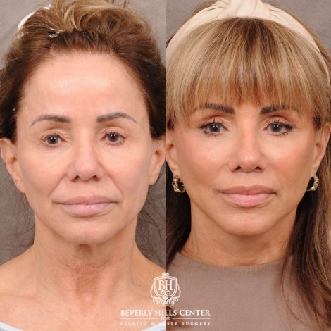 Beverly Hills Center Female Patient Before and After AuraLyft, Cupid Lift Lip Lift, Nanofat