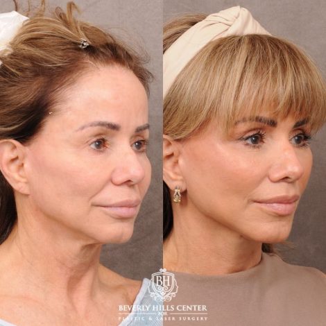 Beverly Hills Center Female Patient Before and After AuraLyft, Cupid Lift Lip Lift, Nanofat