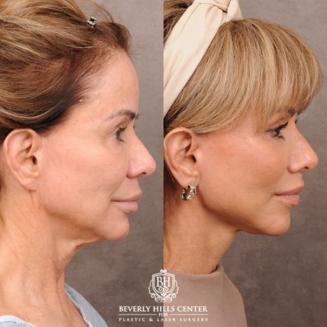 Beverly Hills Center Female Patient Before and After AuraLyft, Cupid Lift Lip Lift, Nanofat