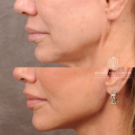 Beverly Hills Center Female Patient Before and After AuraLyft, Cupid Lift Lip Lift, Nanofat