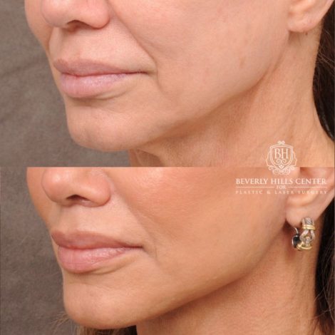 Beverly Hills Center Female Patient Before and After AuraLyft, Cupid Lift Lip Lift, Nanofat