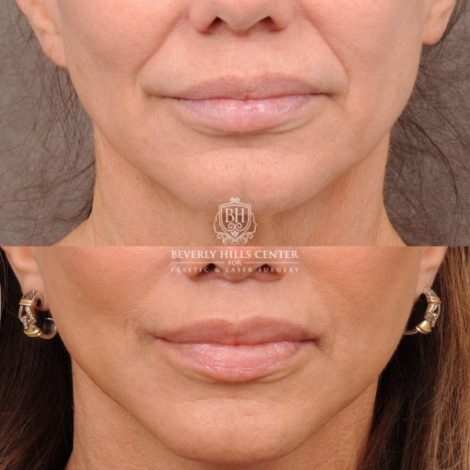 Beverly Hills Center Female Patient Before and After AuraLyft, Cupid Lift Lip Lift, Nanofat