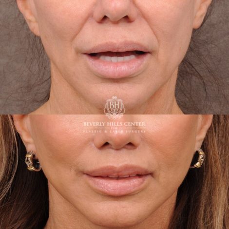 Beverly Hills Center Female Patient Before and After AuraLyft, Cupid Lift Lip Lift, Nanofat