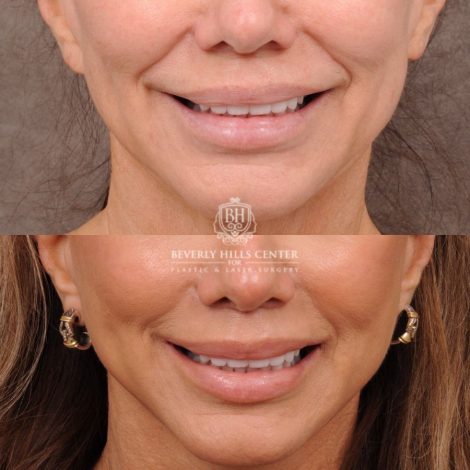 Beverly Hills Center Female Patient Before and After AuraLyft, Cupid Lift Lip Lift, Nanofat
