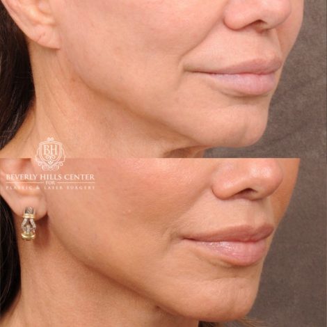 Beverly Hills Center Female Patient Before and After AuraLyft, Cupid Lift Lip Lift, Nanofat