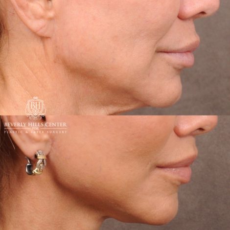 Beverly Hills Center Female Patient Before and After AuraLyft, Cupid Lift Lip Lift, Nanofat