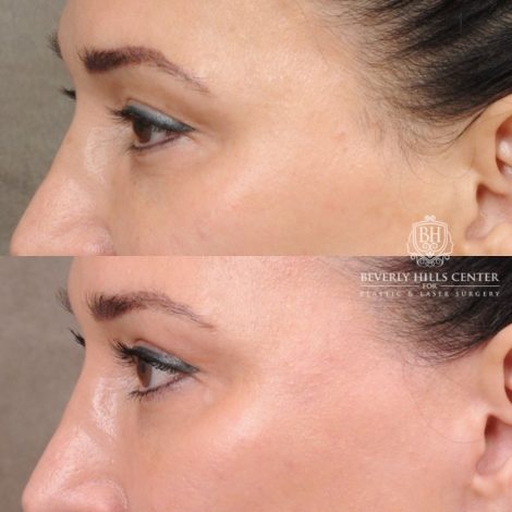 CUPID LIFT® Lip Lift with AuraLyft and Blepharoplasty