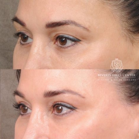 CUPID LIFT® Lip Lift with AuraLyft and Blepharoplasty