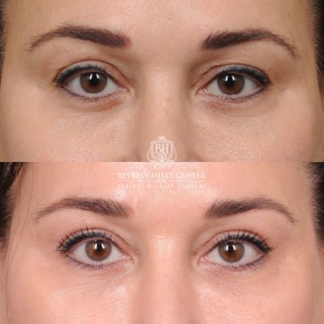 CUPID LIFT® Lip Lift with AuraLyft and Blepharoplasty