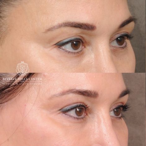 CUPID LIFT® Lip Lift with AuraLyft and Blepharoplasty