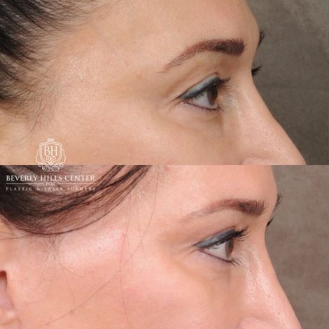 CUPID LIFT® Lip Lift with AuraLyft and Blepharoplasty