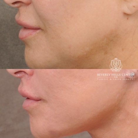 CUPID LIFT® Lip Lift with AuraLyft and Blepharoplasty