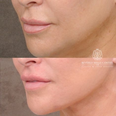 CUPID LIFT® Lip Lift with AuraLyft and Blepharoplasty