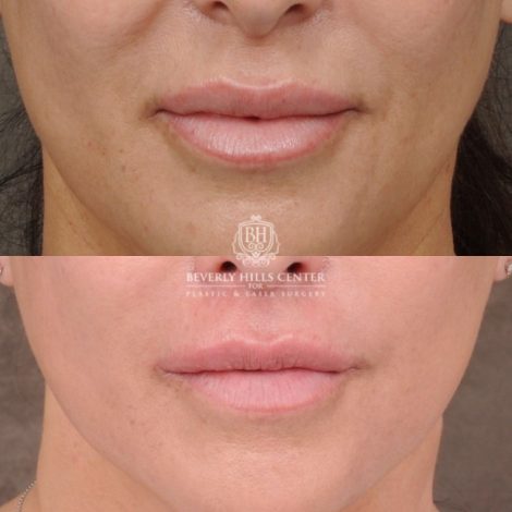CUPID LIFT® Lip Lift with AuraLyft and Blepharoplasty