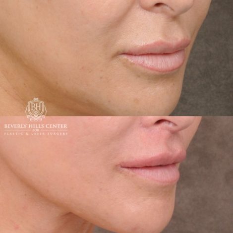 CUPID LIFT® Lip Lift with AuraLyft and Blepharoplasty