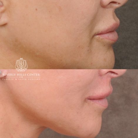 CUPID LIFT® Lip Lift with AuraLyft and Blepharoplasty