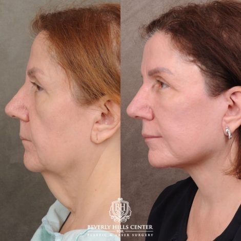 Beverly Hills Center Female Patient Before and After Revision AuraLyft