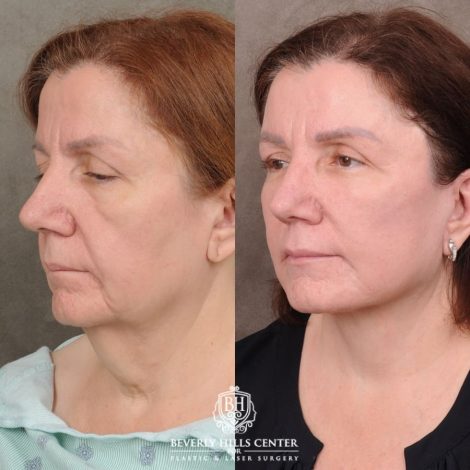 Beverly Hills Center Female Patient Before and After Revision AuraLyft