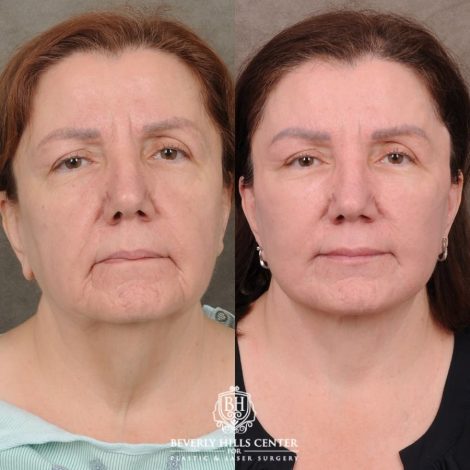 Beverly Hills Center Female Patient Before and After Revision AuraLyft