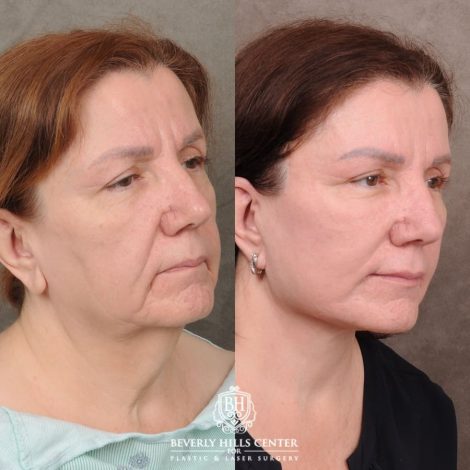 Beverly Hills Center Female Patient Before and After Revision AuraLyft