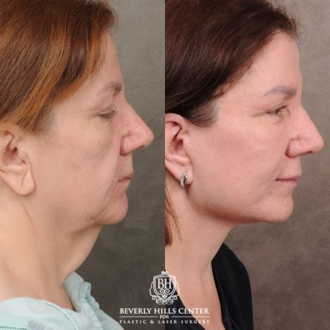 Beverly Hills Center Female Patient Before and After Revision AuraLyft
