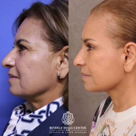 Beverly Hills Center Female Patient Before and After Comprehensive AuraLyft, Blepharoplasty, Temporal Brow Reset, Upper & Lower Blepharoplasty, Ptosis Repair