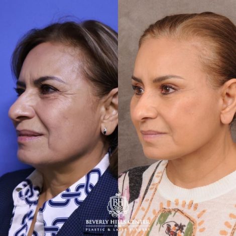 Beverly Hills Center Female Patient Before and After Comprehensive AuraLyft, Blepharoplasty, Temporal Brow Reset, Upper & Lower Blepharoplasty, Ptosis Repair