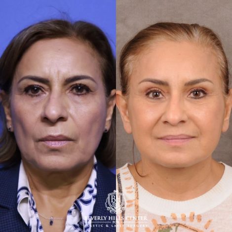 Beverly Hills Center Female Patient Before and After Comprehensive AuraLyft, Blepharoplasty, Temporal Brow Reset, Upper & Lower Blepharoplasty, Ptosis Repair