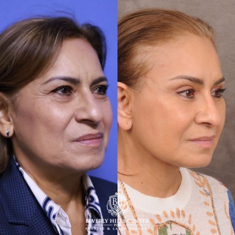 Beverly Hills Center Female Patient Before and After Comprehensive AuraLyft, Blepharoplasty, Temporal Brow Reset, Upper & Lower Blepharoplasty, Ptosis Repair