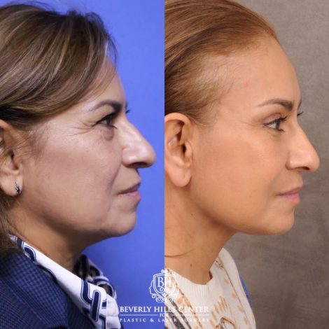 Beverly Hills Center Female Patient Before and After Comprehensive AuraLyft, Blepharoplasty, Temporal Brow Reset, Upper & Lower Blepharoplasty, Ptosis Repair