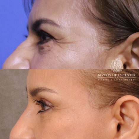 Beverly Hills Center Female Patient Before and After Comprehensive AuraLyft, Blepharoplasty, Temporal Brow Reset, Upper & Lower Blepharoplasty, Ptosis Repair