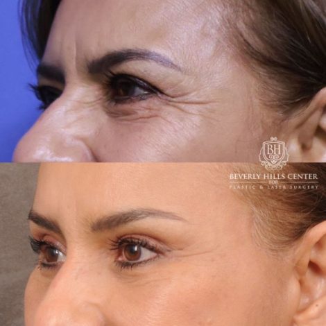 Beverly Hills Center Female Patient Before and After Comprehensive AuraLyft, Blepharoplasty, Temporal Brow Reset, Upper & Lower Blepharoplasty, Ptosis Repair