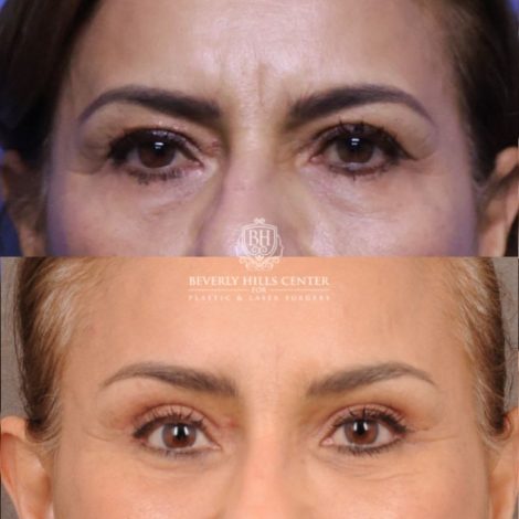 Beverly Hills Center Female Patient Before and After Comprehensive AuraLyft, Blepharoplasty, Temporal Brow Reset, Upper & Lower Blepharoplasty, Ptosis Repair