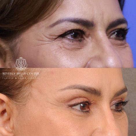 Beverly Hills Center Female Patient Before and After Comprehensive AuraLyft, Blepharoplasty, Temporal Brow Reset, Upper & Lower Blepharoplasty, Ptosis Repair