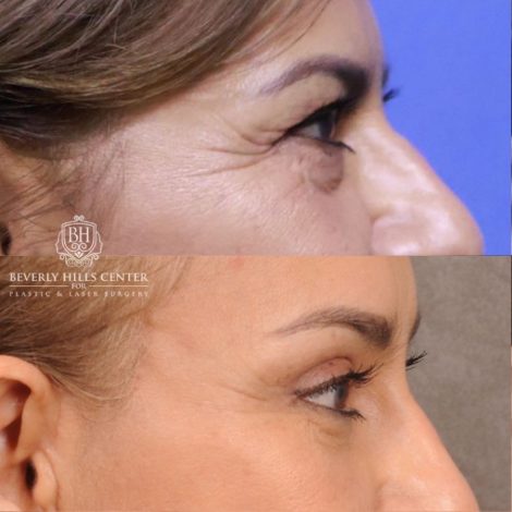 Beverly Hills Center Female Patient Before and After Comprehensive AuraLyft, Blepharoplasty, Temporal Brow Reset, Upper & Lower Blepharoplasty, Ptosis Repair