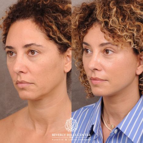 Beverly Hills Center Female Patient Before and After AuraLyft, Temporal Brow Reset, Upper Blepharoplasty