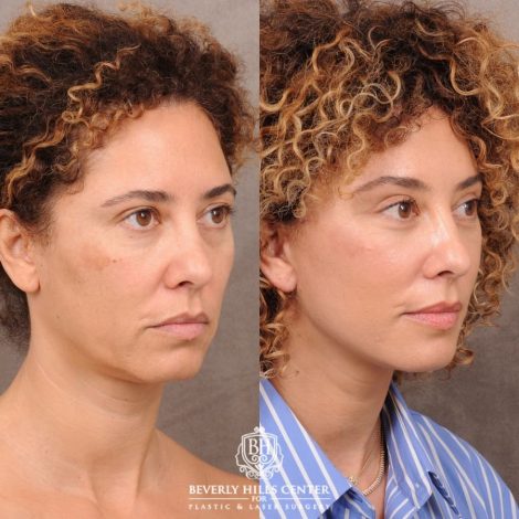Beverly Hills Center Female Patient Before and After AuraLyft, Temporal Brow Reset, Upper Blepharoplasty