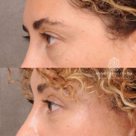 Beverly Hills Center Female Patient Before and After AuraLyft, Temporal Brow Reset, Upper Blepharoplasty