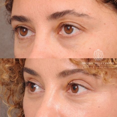 Beverly Hills Center Female Patient Before and After AuraLyft, Temporal Brow Reset, Upper Blepharoplasty