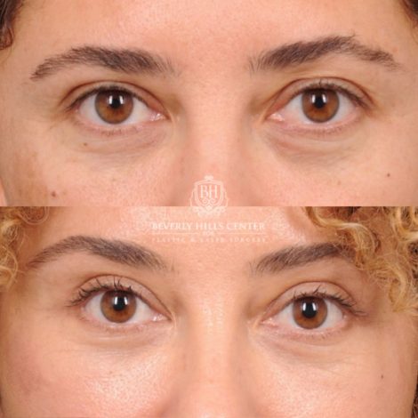 Beverly Hills Center Female Patient Before and After AuraLyft, Temporal Brow Reset, Upper Blepharoplasty
