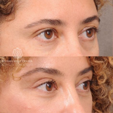 Beverly Hills Center Female Patient Before and After AuraLyft, Temporal Brow Reset, Upper Blepharoplasty