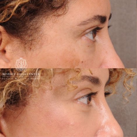Beverly Hills Center Female Patient Before and After AuraLyft, Temporal Brow Reset, Upper Blepharoplasty