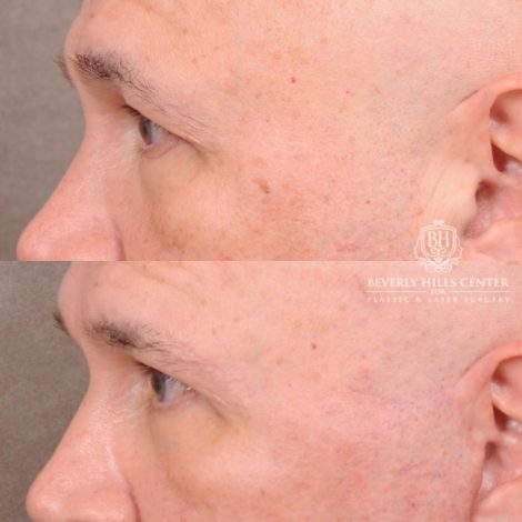 Beverly Hills Center Female Patient Before and After AuraLyft, Temporal Brow Reset, Blepharoplasty, CUPID LIFT® Corner Lift
