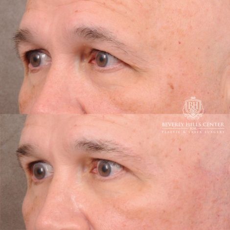 Beverly Hills Center Female Patient Before and After AuraLyft, Temporal Brow Reset, Blepharoplasty, CUPID LIFT® Corner Lift